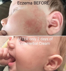 Kem chàm Aveeno Baby Eczema 141gr cho bé