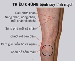 Kem Bôi Giãn Tĩnh Mạch Carusos Veins Care Cream 75Gr Của Úc