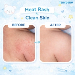 TinyDerm – Kem Phục Hồi Da Bé Dị Ứng Đạm Sữa Bò Nặng | Prebiotics + Postbiotics Nhật Bản Giúp Da Khỏe Từ Gốc 