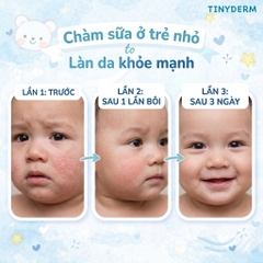 TinyDerm – Kem Phục Hồi Da Bé Dị Ứng Đạm Sữa Bò Nặng | Prebiotics + Postbiotics Nhật Bản Giúp Da Khỏe Từ Gốc 