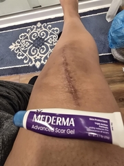 Gel Trị Sẹo Mederma Advanced 20g: Công Dụng, Thành Phần, Giá Bán Và Review Chi Tiết 2026 – Gel Trị Sẹo Mederma Advanced Điều Trị Sẹo Cũ Mới Sẹo Mụn Phẫu Thuật Bỏng Chấn Thương Rạn Da Giảm Vẻ Ngoài Sẹo Làm Mềm Mịn Giảm Đỏ Sẹo An Toàn Không Paraben Không Hương Liệu Chính Hãng Mỹ Giá Rẻ