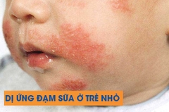 Tổng Quan Về Các Loại Sữa Dành Cho Trẻ Dị Ứng Đạm Sữa Bò: Chỉ Định, Mùi Vị, Tác Dụng Phụ Và Đánh Giá Lâm Sàng