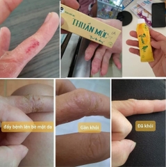 KEM BÔI HỖ TRỢ GIẢM BỆNH NGOÀI DA, THUẦN MỘC XỊN (10) '
