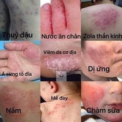 KEM BÔI HỖ TRỢ GIẢM BỆNH NGOÀI DA, THUẦN MỘC XỊN (10) '