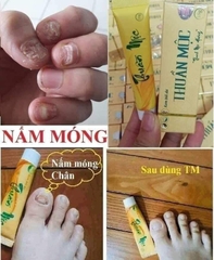 KEM BÔI HỖ TRỢ GIẢM BỆNH NGOÀI DA, THUẦN MỘC XỊN (10) '