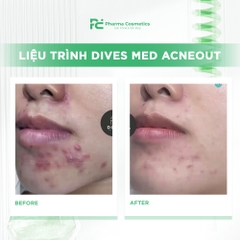 DIVES MED ACNEOUT: Meso Tiêu Cồi Mụn, Bình Thường Hóa Da Dầu Mụn từ Đức
