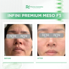 INFINI PREMIUM MESO F5: Giải Pháp Meso Trẻ Hóa Tế Bào Toàn Diện