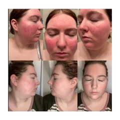Roza 0,75% Metronidazol: Giải Pháp Đặc Trị Chứng Đỏ Mặt Rosacea Và Viêm Da Demodex