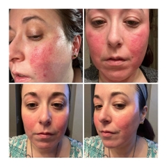 Roza 0,75% Metronidazol: Giải Pháp Đặc Trị Chứng Đỏ Mặt Rosacea Và Viêm Da Demodex
