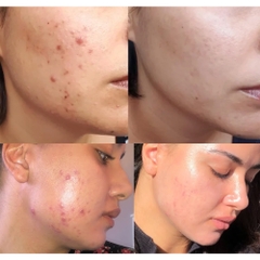 Bailleu Tretin Cream 0.05%: "Tiêu Chuẩn Vàng" Trong Điều Trị Mụn, Trẻ Hóa Da & Hiệu Chỉnh Sắc Tố