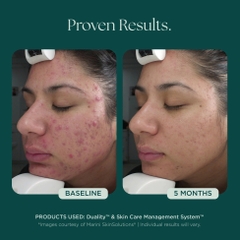 MARINI SKINSOLUTIONS Duality™ – Tinh Chất Hỗ Trợ Giảm Mụn Và Cải Thiện Dấu Hiệu Lão Hóa