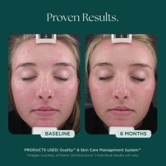 MARINI SKINSOLUTIONS Duality™ – Tinh Chất Hỗ Trợ Giảm Mụn Và Cải Thiện Dấu Hiệu Lão Hóa