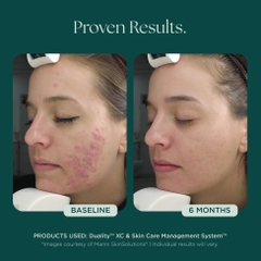 MARINI SKINSOLUTIONS Duality™ – Tinh Chất Hỗ Trợ Giảm Mụn Và Cải Thiện Dấu Hiệu Lão Hóa