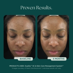 MARINI SKINSOLUTIONS Duality™ – Tinh Chất Hỗ Trợ Giảm Mụn Và Cải Thiện Dấu Hiệu Lão Hóa