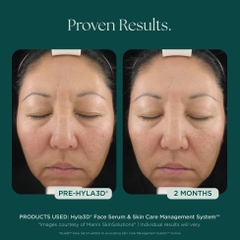 MARINI SKINSOLUTIONS Hyla3D® Face Serum – Tinh Chất Hyaluronic Acid Đa Tầng Hỗ Trợ Cấp Ẩm Và Giúp Da Trông Căng Đầy