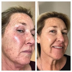 Elaine Brennan GetGlowing Micro-Peel – Liệu Trình Peel Chuyên Nghiệp Hỗ Trợ Làm Sáng Và Cải Thiện Bề Mặt Da