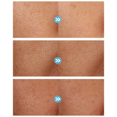 LIỆU PHÁP CO2 CARBOXY: Thanh Lọc Da Chuyên Sâu, Trẻ Hóa Không Xâm Lấn