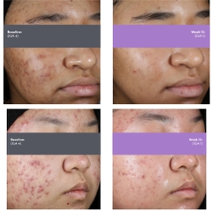 AKLIEF® Trifarotene Cream 0.005% (30g) Retinoid thế hệ mới hỗ trợ điều trị mụn mặt & mụn cơ thể