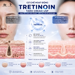 TRETINOIN TARO CREAM USP: Liệu Pháp Đặc Trị Mụn, Nếp Nhăn & Sắc Tố Với Hiệu Quả Đã Được FDA Công Nhận