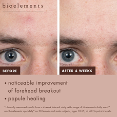 Bioelements Spot Defy – Kem Chấm Mụn Lưu Huỳnh 5% Giúp Giảm Mụn Qua Đêm