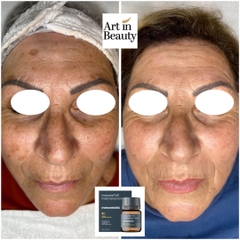 MESOPEEL® MD MELANOSTOP TRANEX: Giải Pháp Peel Đặc Trị Nám & Tăng Sắc Tố Chuyên Sâu