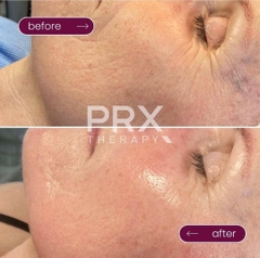 WIQO PRX-T33: Biorevitalization Thế Hệ Mới - Trẻ Hóa Da, Săn Chắc & Sáng Rạng Ngay Lập Tức