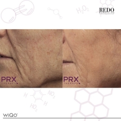 WIQO PRX-T33: Biorevitalization Thế Hệ Mới - Trẻ Hóa Da, Săn Chắc & Sáng Rạng Ngay Lập Tức