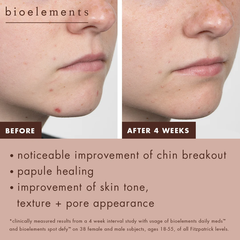 Bioelements Daily Meds – Tinh Chất Trị Mụn 2% Salicylic Acid Làm Thông Thoáng Lỗ Chân Lông