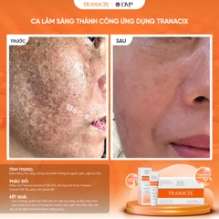 Tranacix Cream 3% – Giải Pháp Đột Phá Điều Trị Nám, Hồng Ban & Tăng Sắc Tố