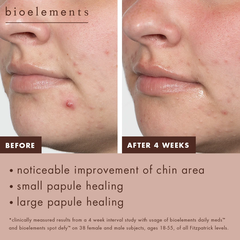 Bioelements Spot Defy – Kem Chấm Mụn Lưu Huỳnh 5% Giúp Giảm Mụn Qua Đêm