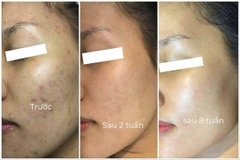 COMBO TRỊ NÁM, DƯỠNG SÁNG & PHỤC HỒI DA TOÀN DIỆN CASMARA (NIGHT & DAY)