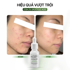 SKINMTX 2% Salicylic Acid Acti-Clear Lotion: Giải Pháp Loại Bỏ Mụn Đầu Đen & Thông Thoáng Lỗ Chân Lông
