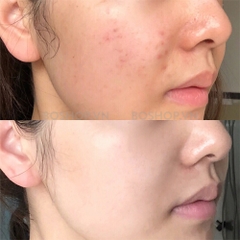 AZCLEAR ACTION AZELAIC ACID 20% 25g / KEM DƯỠNG GIẢM MỤN, MỜ THÂM