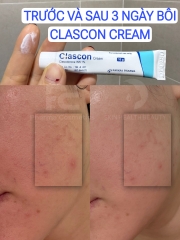 CLASCON CREAM (CLASCOTERONE 1%): Đột Phá Mới Trong Điều Trị Mụn Nội Tiết & Giảm Nhờn