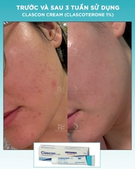 CLASCON CREAM (CLASCOTERONE 1%): Đột Phá Mới Trong Điều Trị Mụn Nội Tiết & Giảm Nhờn