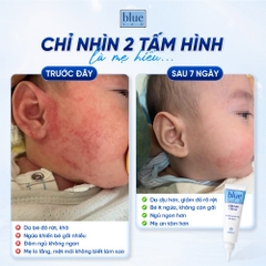 Blue Cap Cream 50g – Kem dưỡng ẩm sâu, hỗ trợ làm dịu da khô và nhạy cảm