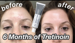 Obagi Tretinoin 0.025% Cream – Kem Dưỡng Hỗ Trợ Giảm Mụn & Cải Thiện Bề Mặt Da Mịn Màng