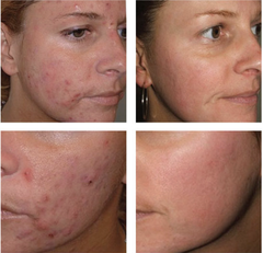 Obagi Tretinoin 0.1% Cream – Kem Dưỡng Chuyên Sâu Tối Ưu Bề Mặt & Hỗ Trợ Giảm Mụn Cấp Độ Cao