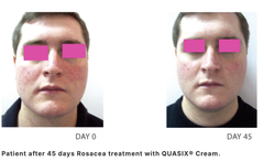 QUASIX GEL 30g / GEL ĐỂ KIỂM SOÁT TÌNH TRẠNG ĐỎ BỪNG MẶT VÀ BỆNH ROSACEA Ở DA NHỜN ( DA DẦU, DA HỖN HỢP) 