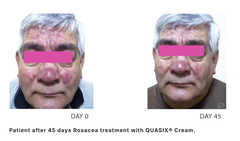 QUASIX GEL 30g / GEL ĐỂ KIỂM SOÁT TÌNH TRẠNG ĐỎ BỪNG MẶT VÀ BỆNH ROSACEA Ở DA NHỜN ( DA DẦU, DA HỖN HỢP) 