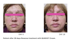 QUASIX CREAM / KEM DƯỠNG CHO LÀN DA ỬNG ĐỎ, ROSACEA (DA KHÔ, DA THƯỜNG)