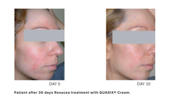 QUASIX CREAM / KEM DƯỠNG CHO LÀN DA ỬNG ĐỎ, ROSACEA (DA KHÔ, DA THƯỜNG)