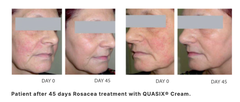 QUASIX CREAM / KEM DƯỠNG CHO LÀN DA ỬNG ĐỎ, ROSACEA (DA KHÔ, DA THƯỜNG)