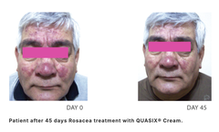 QUASIX CREAM / KEM DƯỠNG CHO LÀN DA ỬNG ĐỎ, ROSACEA (DA KHÔ, DA THƯỜNG)