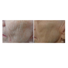 ANTEAGE MD® GROWTH FACTOR SOLUTION / TINH CHẤT PHỤC HỒI LÀN DA VÀ LÀNH THƯƠNG 
