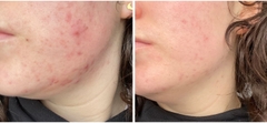 PHARMAFORM ACNE CLARIFYING PLUS SERUM: Tinh Chất Trị Mụn & Chống Lão Hóa Cho Làn Da Trưởng Thành