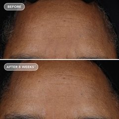 IMAGE Skincare AGELESS+ Retinol Pure Liquid Retinol 0.75% – Serum retinol tinh khiết dành cho người đã sử dụng retinol nồng độ cao da dầu, mụn