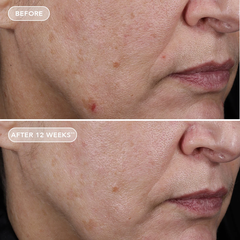 IMAGE Skincare AGELESS+ Retinol Pure Liquid Retinol 0.75% – Serum retinol tinh khiết dành cho người đã sử dụng retinol nồng độ cao da dầu, mụn