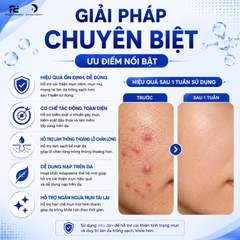 Aldocont B Gel: Giải Pháp Hỗ Trợ Điều Trị Mụn Viêm, Mụn Mủ & Ngăn Ngừa Thâm Sạm Toàn Diện