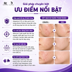 Aldocont C Gel: Giải Pháp Hỗ Trợ Điều Trị Mụn Trứng Cá, Mụn Viêm & Dày Sừng Từ Adapalene & Clindamycin